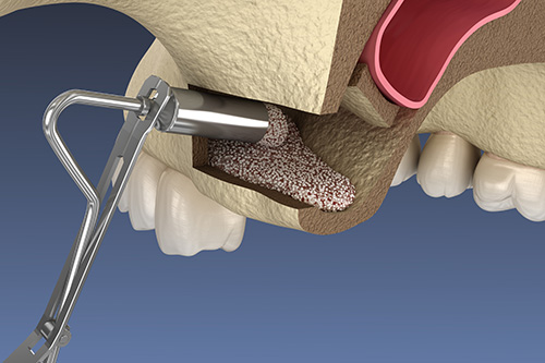 Sinus Lift