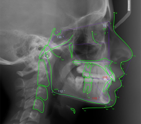 Teleradiography of the profile